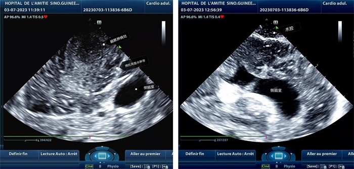 左圖顯示術(shù)中超聲見囊實(shí)性病變，大小約為4x4x3cm，病灶周圍腦組織水腫明顯；右圖為病灶切除后，術(shù)中超聲示術(shù)腔無病變殘留